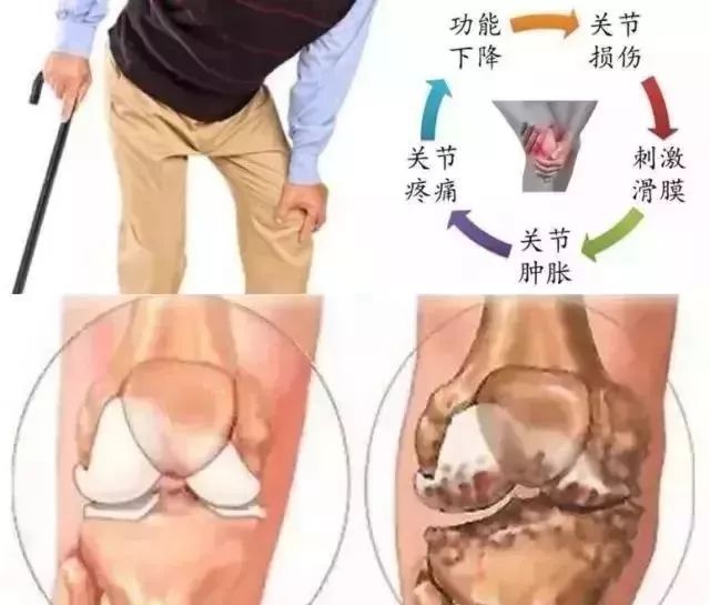 滑膜炎康复训练，90%的人都犯过这些误区！