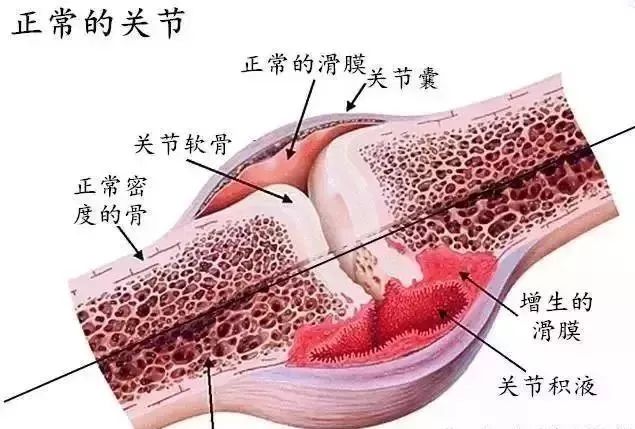 滑膜炎康复训练，90%的人都犯过这些误区！