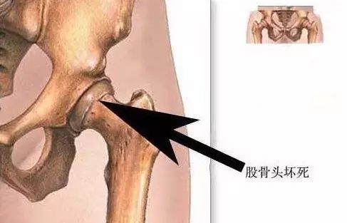 激素性股骨头坏死的症状是怎么表现的