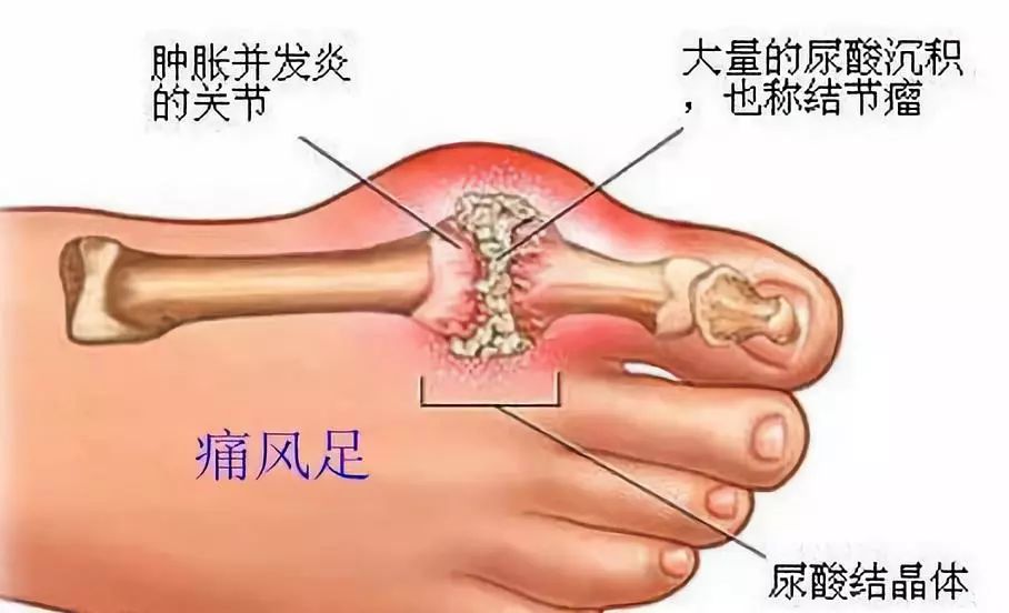 痛风、风湿和类风湿关节炎三者之间如何区分，看完这篇不再混淆！