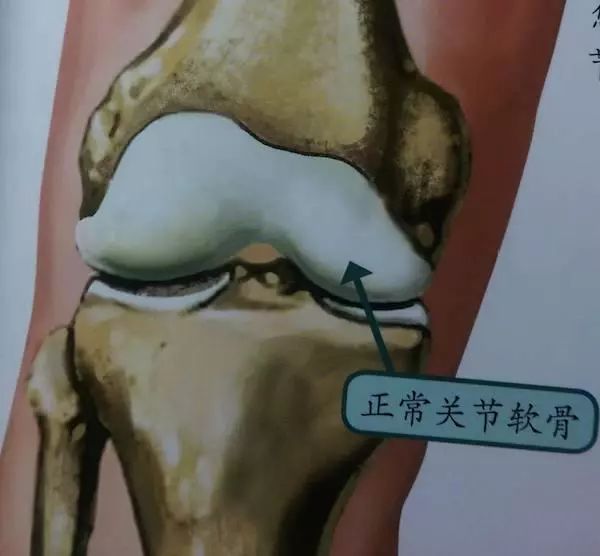 人工关节可以用多久？如何保养能用的更久？