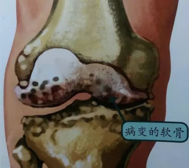 人工关节可以用多久？如何保养能用的更久？