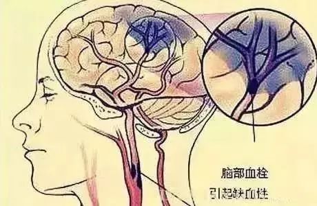 入冬后，中老年人一定要刮刮这条青筋，防治脑血栓