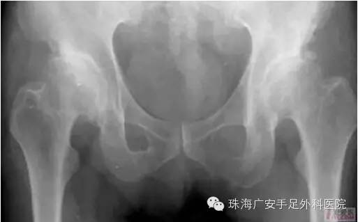 广安医院带你认出骨关节病三大特征