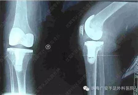 广安医院带你认出骨关节病三大特征