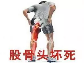 老人胯骨（髋关节）痛，是不是就是股骨头坏死了？