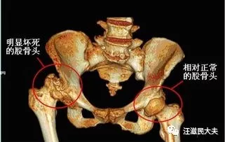 老人胯骨（髋关节）痛，是不是就是股骨头坏死了？