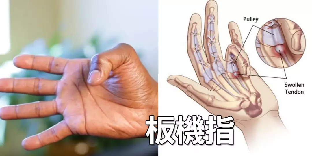 手指疼痛难以伸直？快来看看是不是得了腱鞘炎！