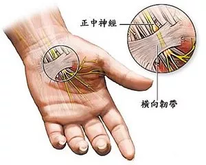 手腕酸痛的几个原因