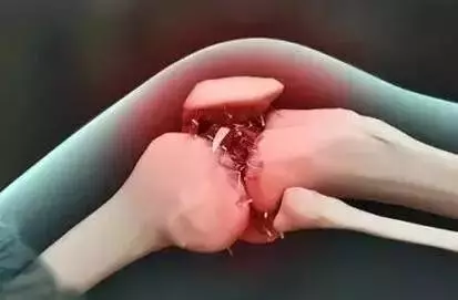 长骨刺了怎么办，可以消除吗？