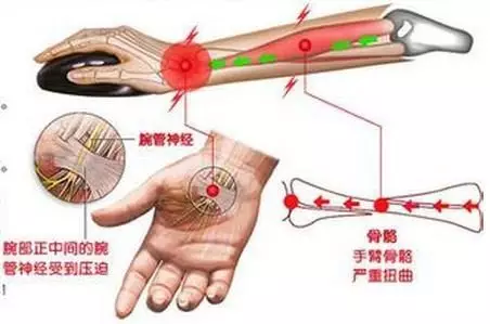 半夜“手麻”？快看看自己是不是得了这种病