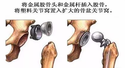 年纪轻轻，置换人工关节有问题吗