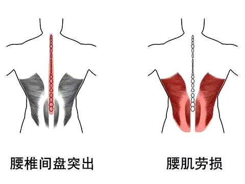 ​长期腰痛,可能是腰肌劳损