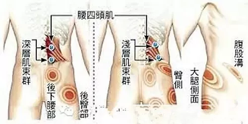 腰背痛也可能是肌筋膜炎