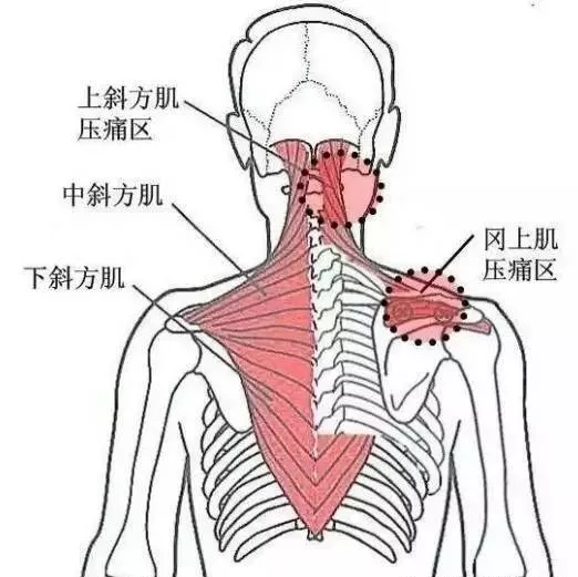 腰背痛也可能是肌筋膜炎