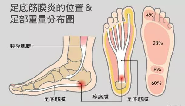 腰背痛也可能是肌筋膜炎