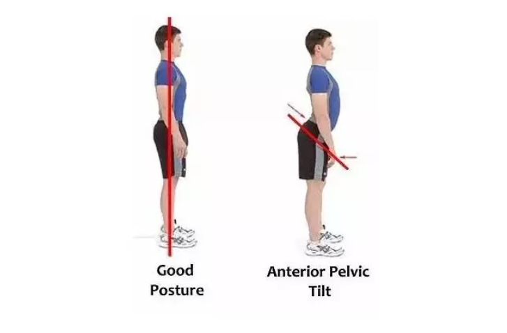 大腹便便引起的腰疼？其实是下交叉综合症在作怪