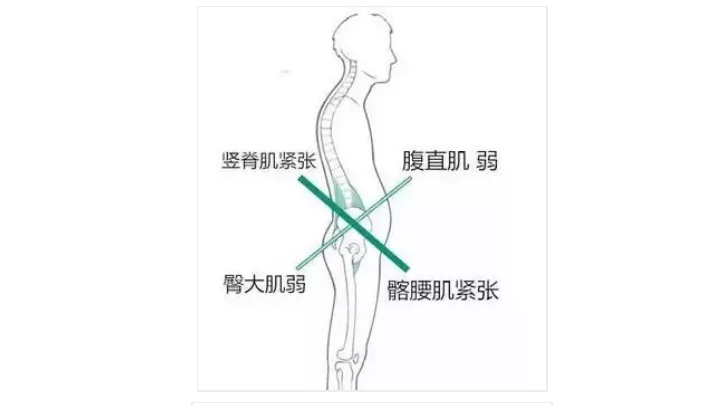 大腹便便引起的腰疼？其实是下交叉综合症在作怪