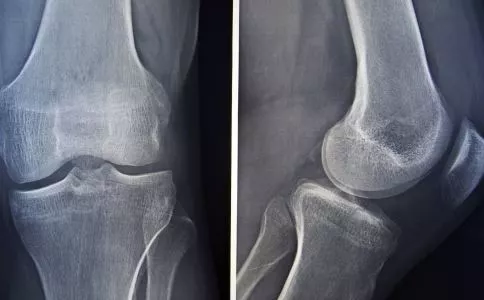 警惕腰背疼痛可能是腰椎间盘突出 图片