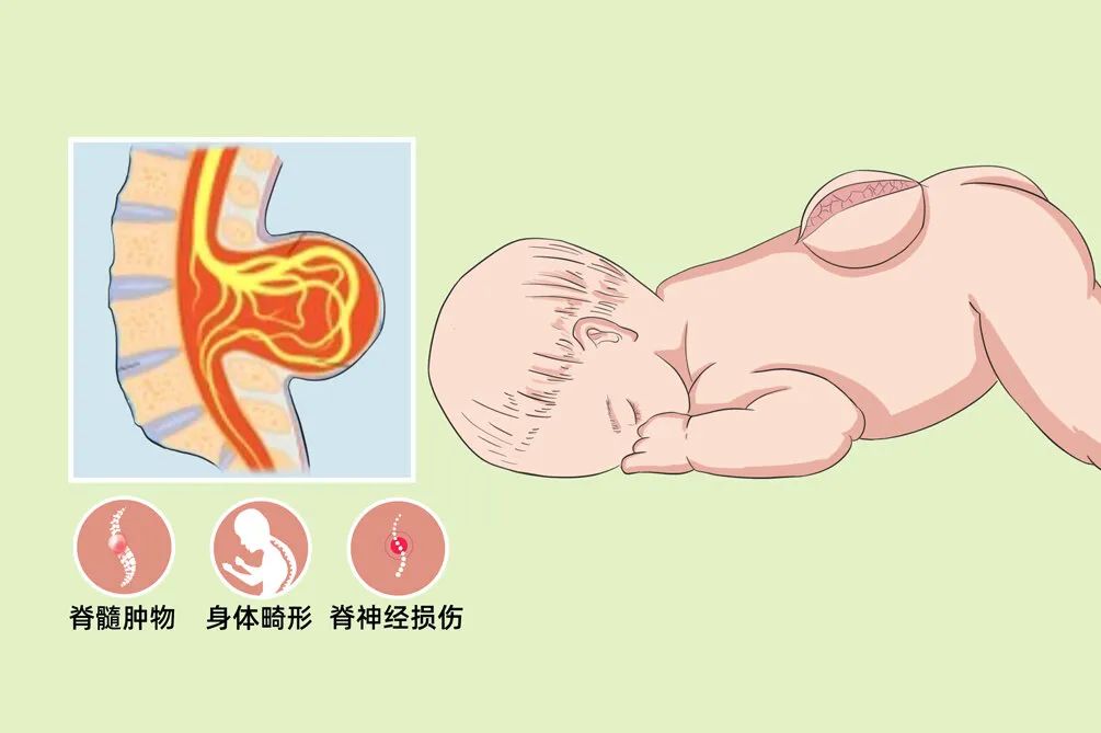 婴幼儿时期就会展现出来的脊柱裂，该如何发现？