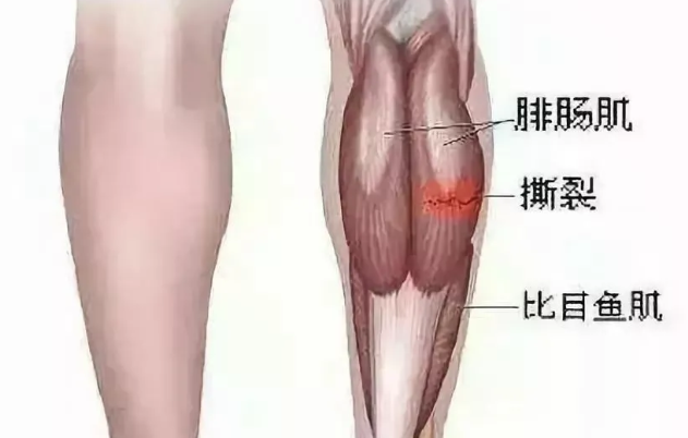 肌肉损伤应该早期活动还是限制活动？